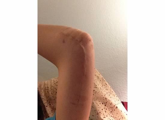 Scar